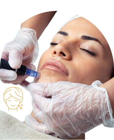 Microneedling For Acne Scars
