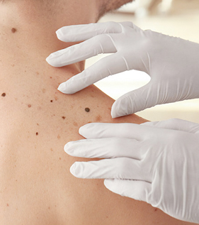 Acne Treatment in Ahmedabad